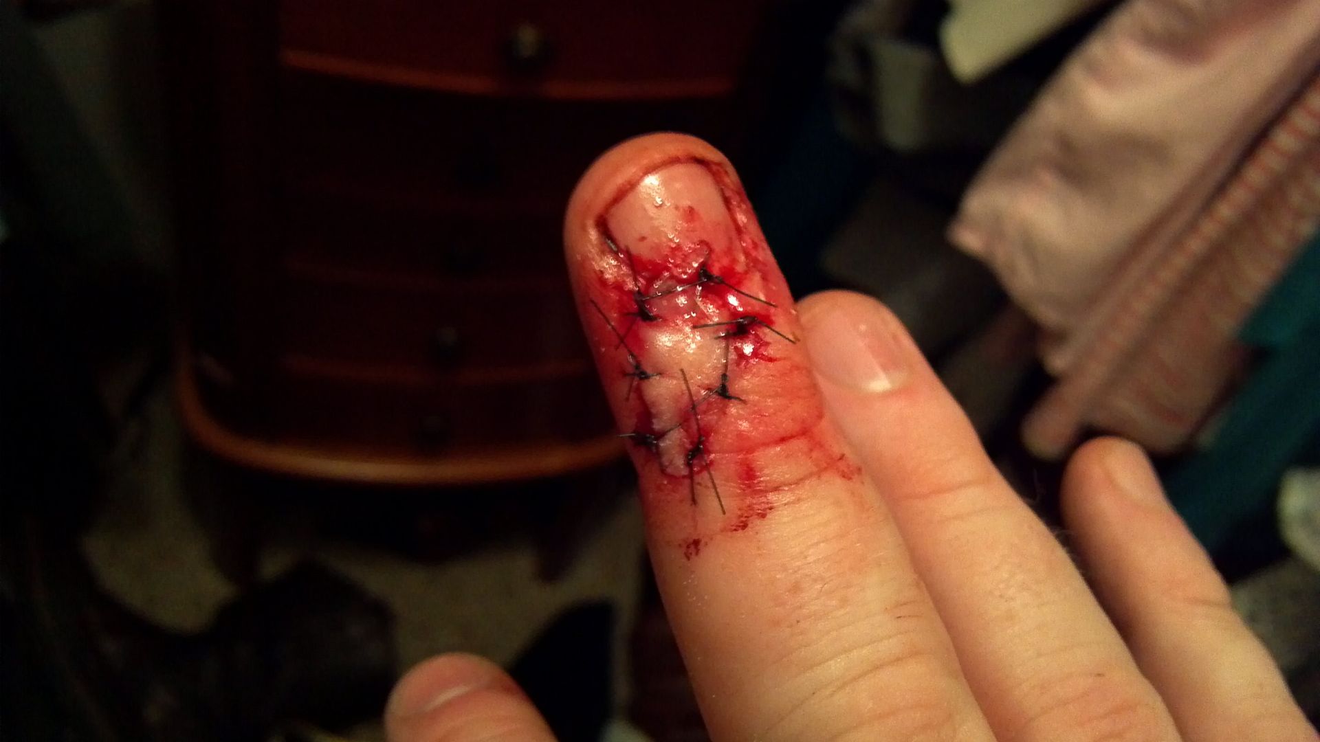 how do i know if my stitches are infected how do i know if my stitches are infected