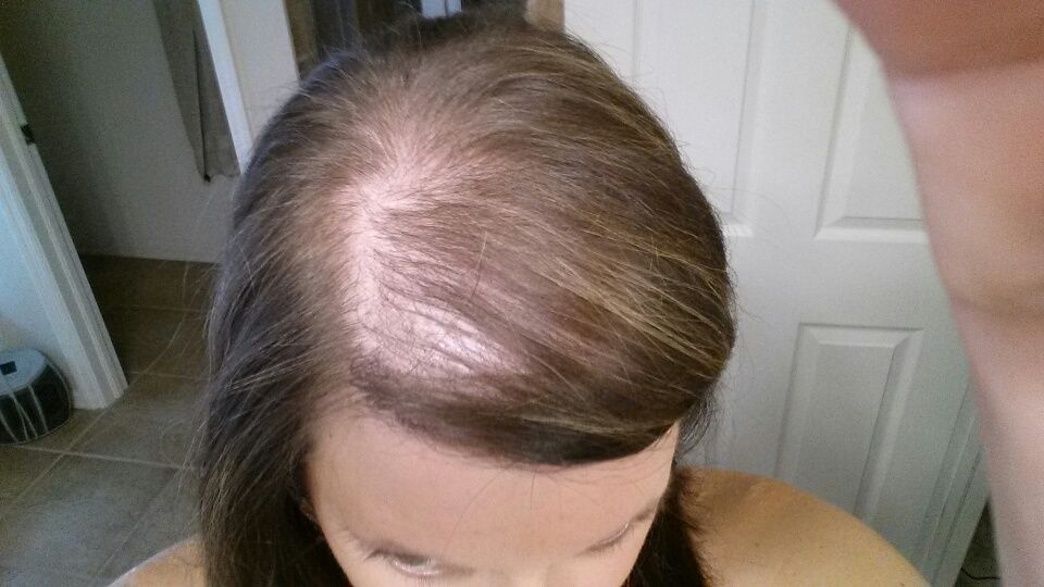 Pregnancy And Hair Loss Or Thinning Photo