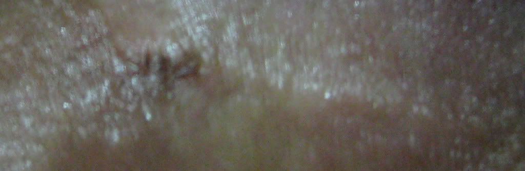 dark spot on shaft of penis Lindsay lohan sexual orientation